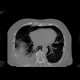 Perforation of oesophagus, pneumomediastinum: CT - Computed tomography